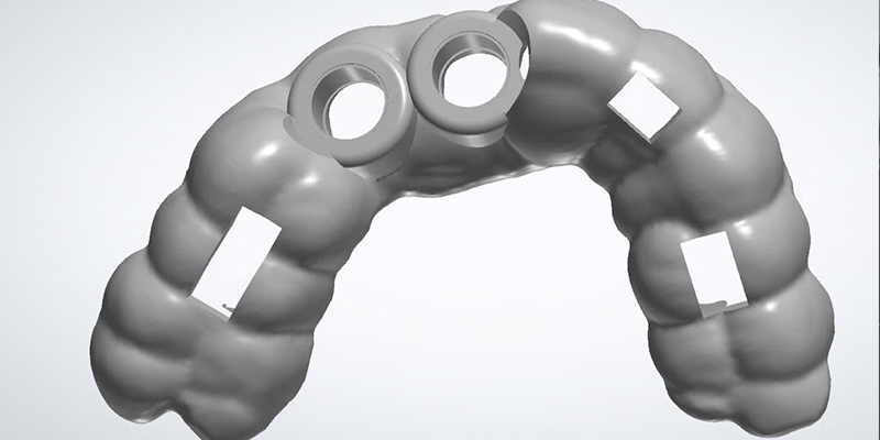 SINGLE IMPLANT SURGICAL GUIDE