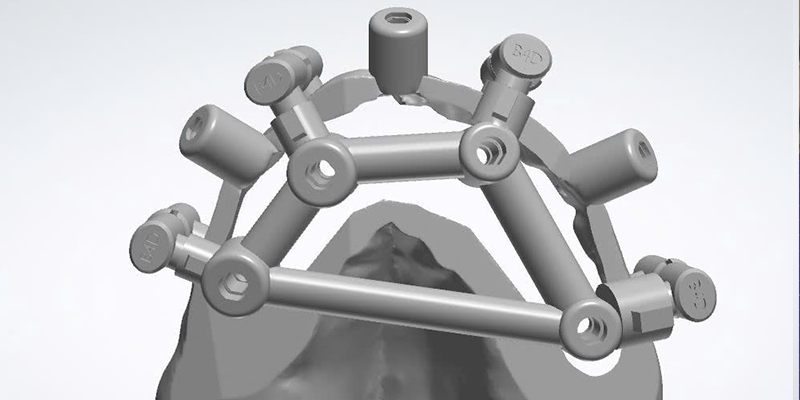 STACKABLE SURGICAL GUIDE