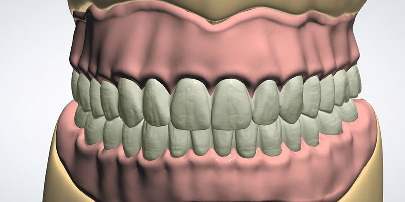 FULL DENTURE