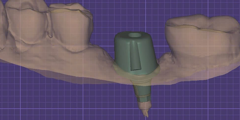 CUSTOM ABUTMENT